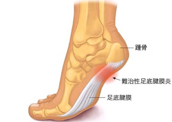 難治性足底腱膜炎のイラスト