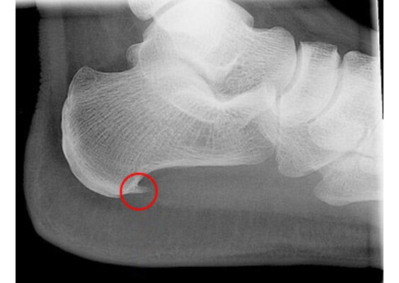 足底腱膜炎（足底筋膜炎）の画像所見