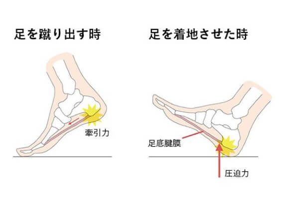 足底腱膜炎（足底筋膜炎）の原因・メカニズムのイラスト