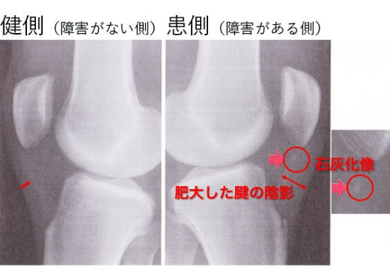 ジャンパー膝の画像診断(X線)