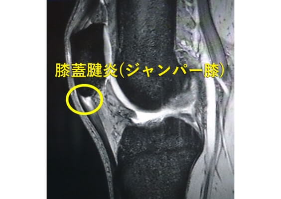 ジャンパー膝の画像診断(MRI)