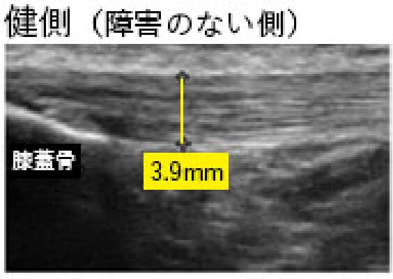 ジャンパー膝の画像診断(超音波エコー)健側
