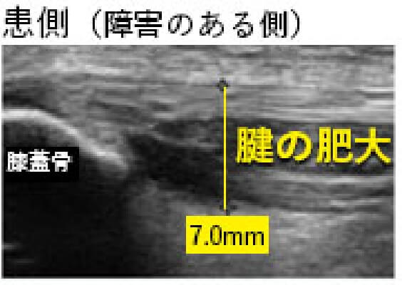 ジャンパー膝の画像診断(超音波エコー)患側