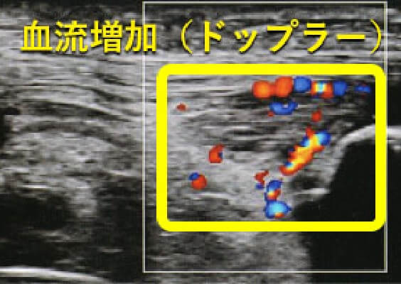 ジャンパー膝の画像診断(超音波エコー)ドップラー