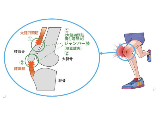 ジャンパー膝の発症メカニズムのイラスト
