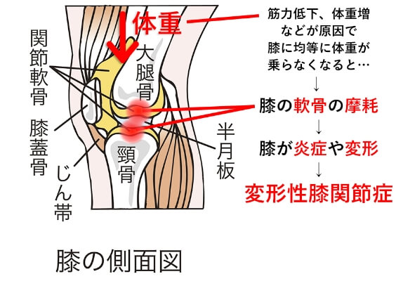 変形性膝関節症の原因のイラスト