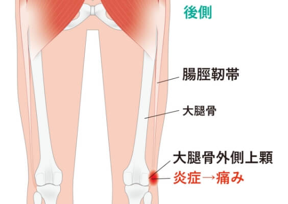 ランナー膝の症状のイラスト