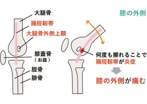 ランナー膝の症状の原因・メカニズムのイラスト