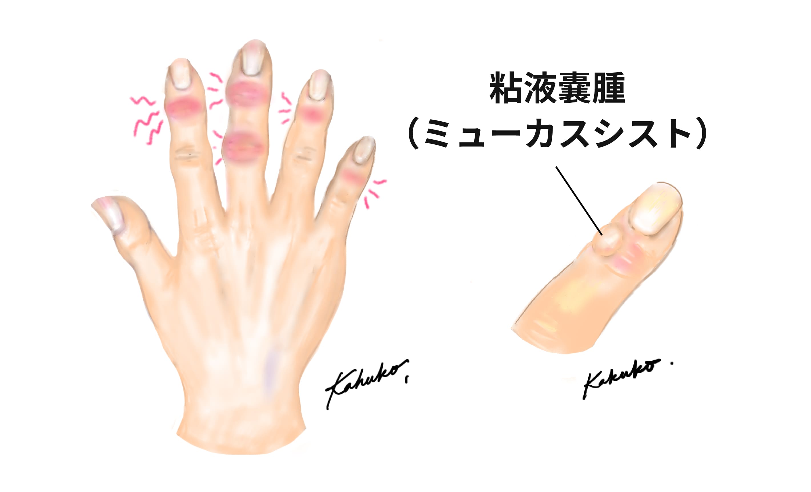 へバーデン結節のメカニズム